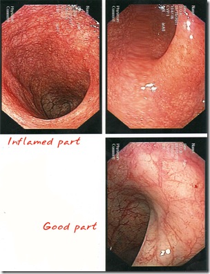 colonoscopy ulcerative colitis